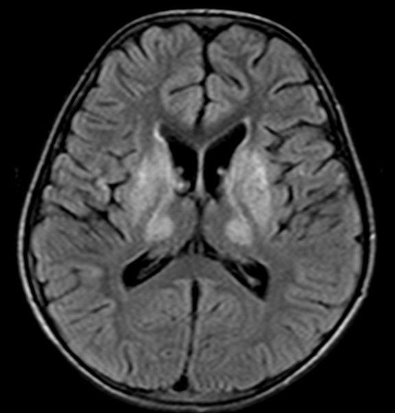 Increased T2 signal of the symmetric basal ganglia, including the caudate nuclei, putamina, as well as ventrolateral thalami, without the restriction of diffusion.