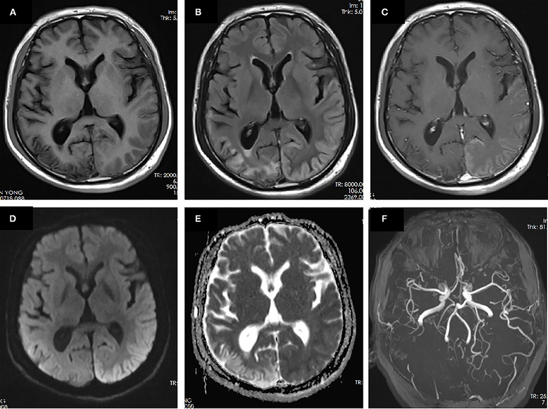 Figure 2: MRI performed 10 days after onset of the second prolonged attack. Right temporal-occipital hyperintensity on T1-weighted images (A) with gliosis on T2-FLAIR images (B) suggests the chronic stage of cortical necrosis caused by first prolonged attack. Left temporal–occipital cortex hyperintensity on T2-FLAIR images (B) with gyriform enhancement (C), restricted diffusion (D), and normal apparent diffusion coefficient (ADC) (E) suggests the subacute stage of cortical necrosis caused by second prolonged attack. MRA demonstrated vasodilation of the branches of the left middle cerebral artery (MCA) and posterior cerebral artery (PCA) (F). 