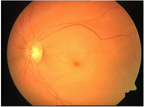 Source : Figure 1 Fieß, A., Cal, Ö., Kehrein, S. et al. Anterior chamber paracentesis after central retinal artery occlusion: a tenable therapy?. BMC Ophthalmol 14, 28 (2014). https://doi.org/10.1186/1471-2415-14-28 