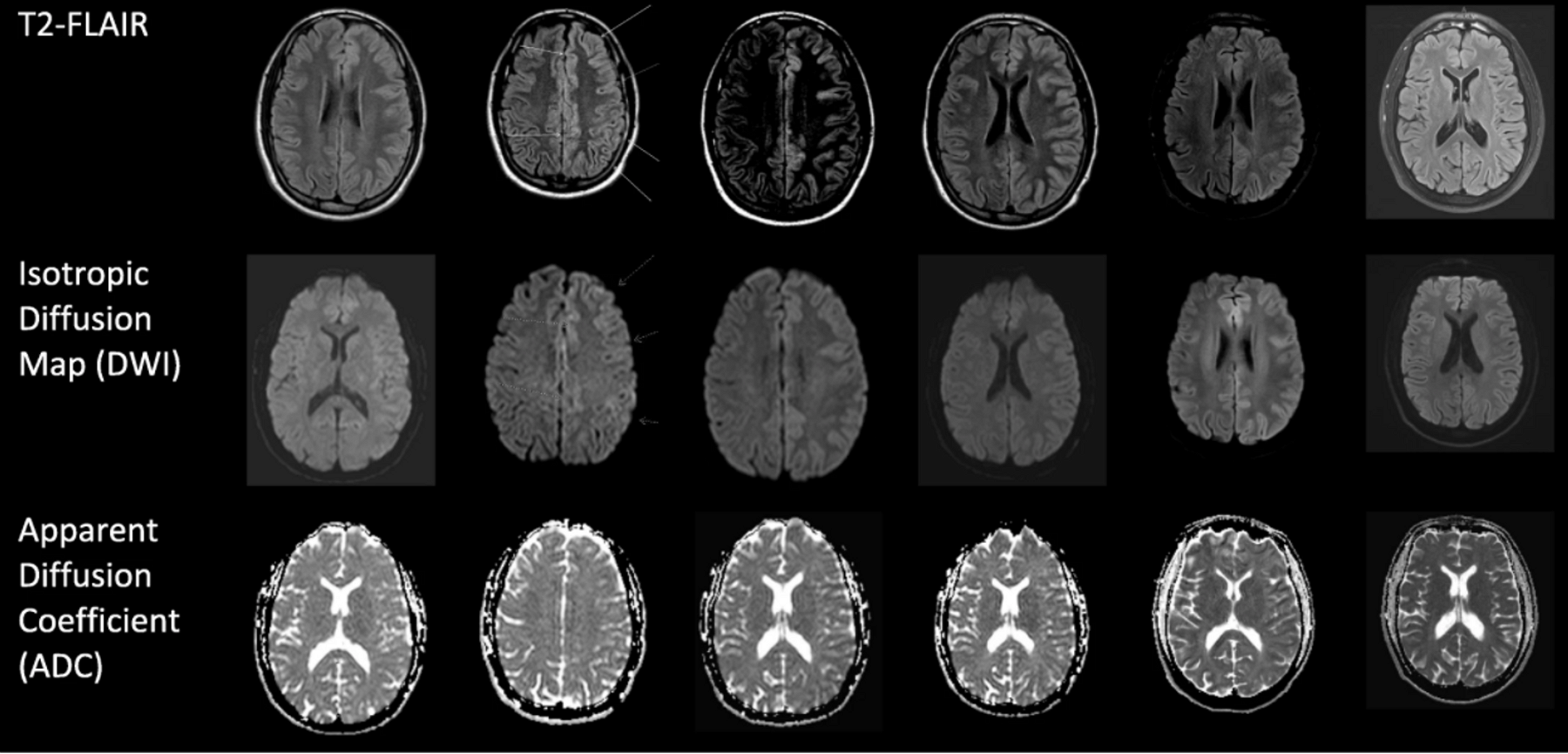 Figure 1: From Left to Right: MRI done on days 2, 4, 7, 11, 15, 154. MRI obtained on day 2 did not reveal any acute intracranial abnormality. However, scattered, non-enhancing punctate T2-FLAIR hyperintensities in subcortical white matter were present bilaterally in the frontal lobes. Day 4: Diffuse DWI and T2-FLAIR hyperintensities throughout the left cerebral hemisphere cortices, most pronounced over the lateral convexity. Possible associated T2 shine through rather than restricted diffusion. Associated sulcal effacement from gyral swelling. Day 7:Diffuse DWI and T2-FLAIR hyperintensities throughout the left cerebral hemisphere cortices similar to the MRI findings obtained on day 4. Subtle hypointensity on ADC in left cerebral hemisphere cortices and posterior temporal lobe. Day 11: Diffuse DWI and T2-FLAIR hyperintensities throughout the left cerebral hemisphere cortices similar to previous MRI findings. Mild hypointensity on ADC in the left cerebral hemisphere cortices and temporal lobe is more prominent compared to previous MRIs. Day 15: Diffuse DWI and T2-FLAIR hyperintensities throughout the left cerebral hemisphere cortices similar to previous MRIs. Mild hypointensity on ADC in left cerebral hemisphere cortices is even more prominent compared to previous MRIs. Day 154:Previously demonstrated left cerebral hemisphere cortical swelling and restricted diffusion has resolved. No new parenchymal signal abnormality or abnormal enhancement. Scattered non-enhancing punctate T2-FLAIR hyperintensities were present in subcortical white matter of bilateral frontal lobes similar to the first MRI 