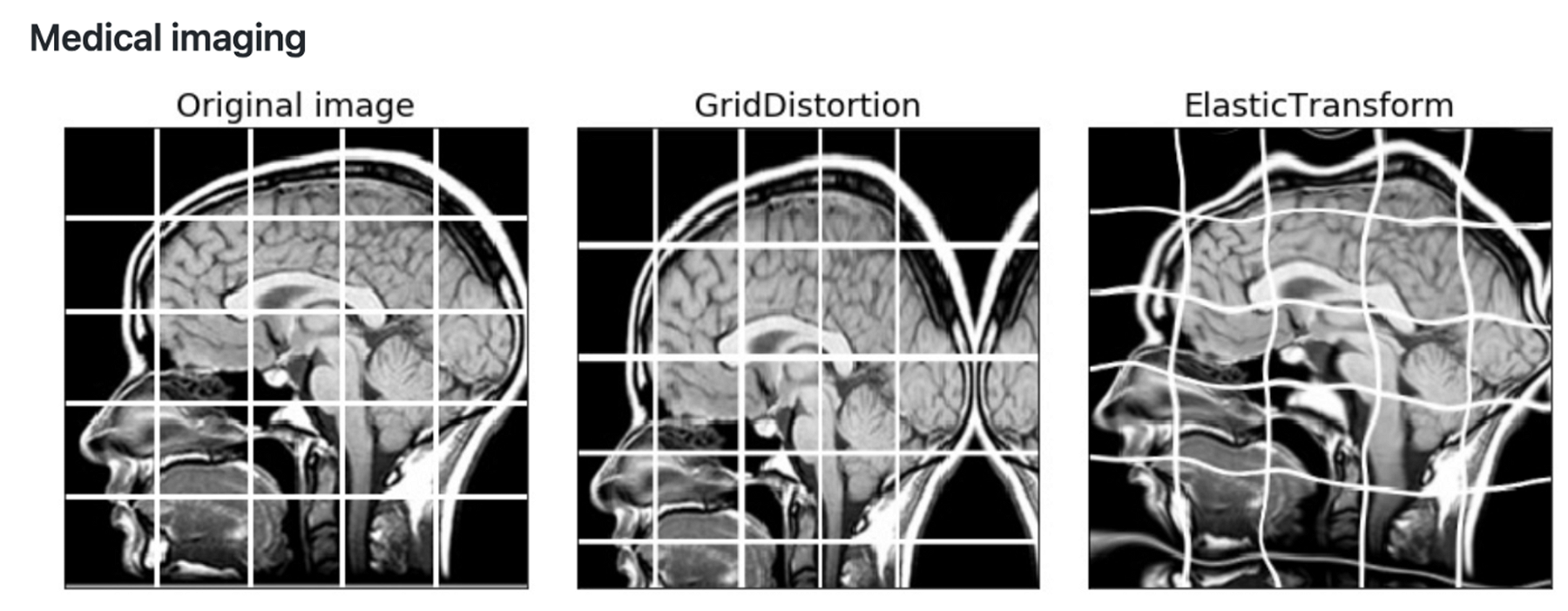 Grid Distortion, Elastic Transform(출처 : Albumentation)